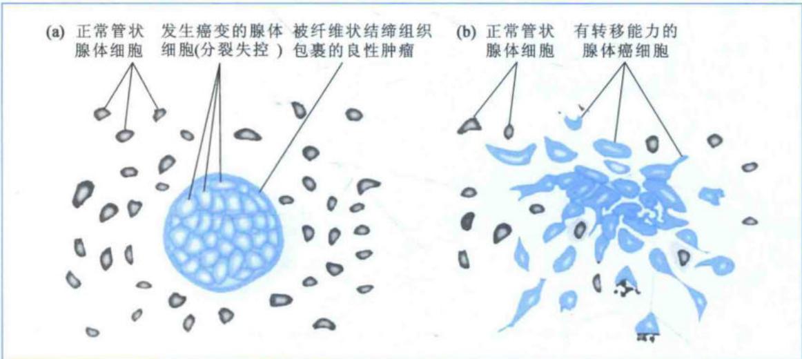 良性肿瘤与恶性肿瘤的组织特征